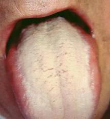 舌苔2
